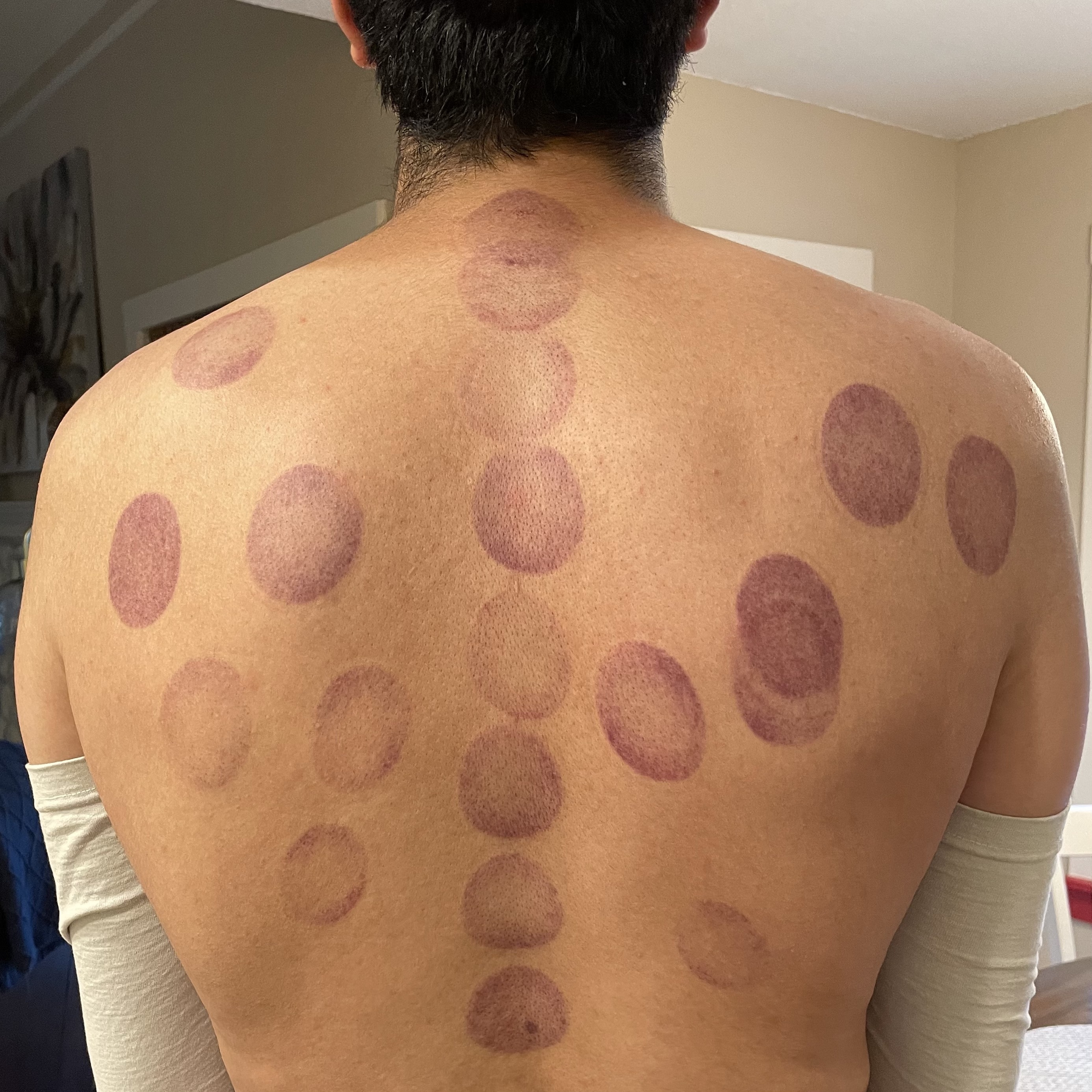 Cupping